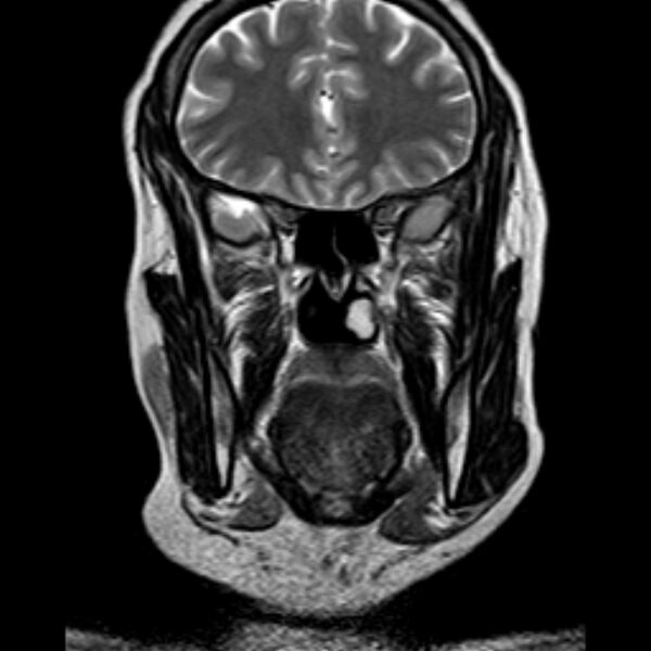 File:Neurofibromatosis type 2 (Radiopaedia 67470-76871 Coronal T2 1).jpg