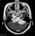 Neurofibromatosis type 2 - cranial and spinal involvement (Radiopaedia 5351-7111 Axial T1 C+ 4).jpg