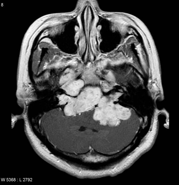 File:Neurofibromatosis type 2 - cranial and spinal involvement (Radiopaedia 5351-7111 Axial T1 C+ 4).jpg