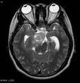 Neurofibromatosis type 2 - cranial and spinal involvement (Radiopaedia 5351-7111 Axial T2 9).jpg