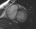 Non-compaction of the left ventricle (Radiopaedia 69436-79314 Short axis cine 179).jpg