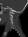 Normal CT cervical spine - pediatric (Radiopaedia 52549-58462 Sagittal bone window 177).jpg