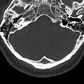 Normal CT of the cervical spine (Radiopaedia 53322-59305 Axial bone window 12).jpg