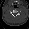 Normal CT of the cervical spine (Radiopaedia 53322-59305 Axial bone window 142).jpg