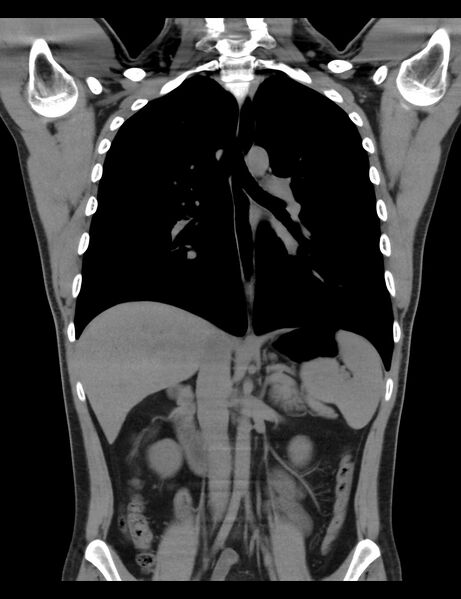 File:Normal CT virtual gastroscopy (Radiopaedia 29960-30501 E 4).jpg
