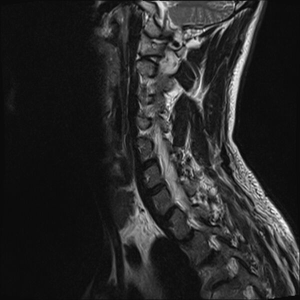 File:Normal cervical spine MRI (Radiopaedia 38418-40496 Sagittal T2 10).jpg
