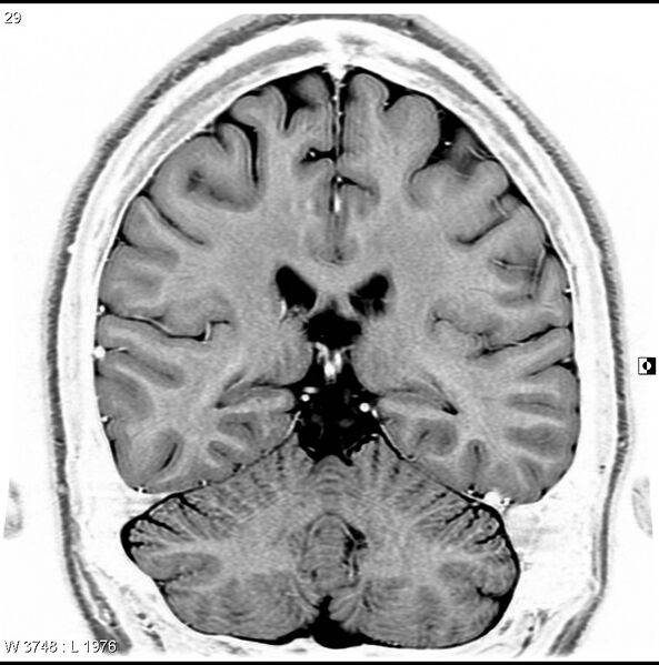 File:Normal coronal brain (Radiopaedia 6676-7910 B 29).jpg