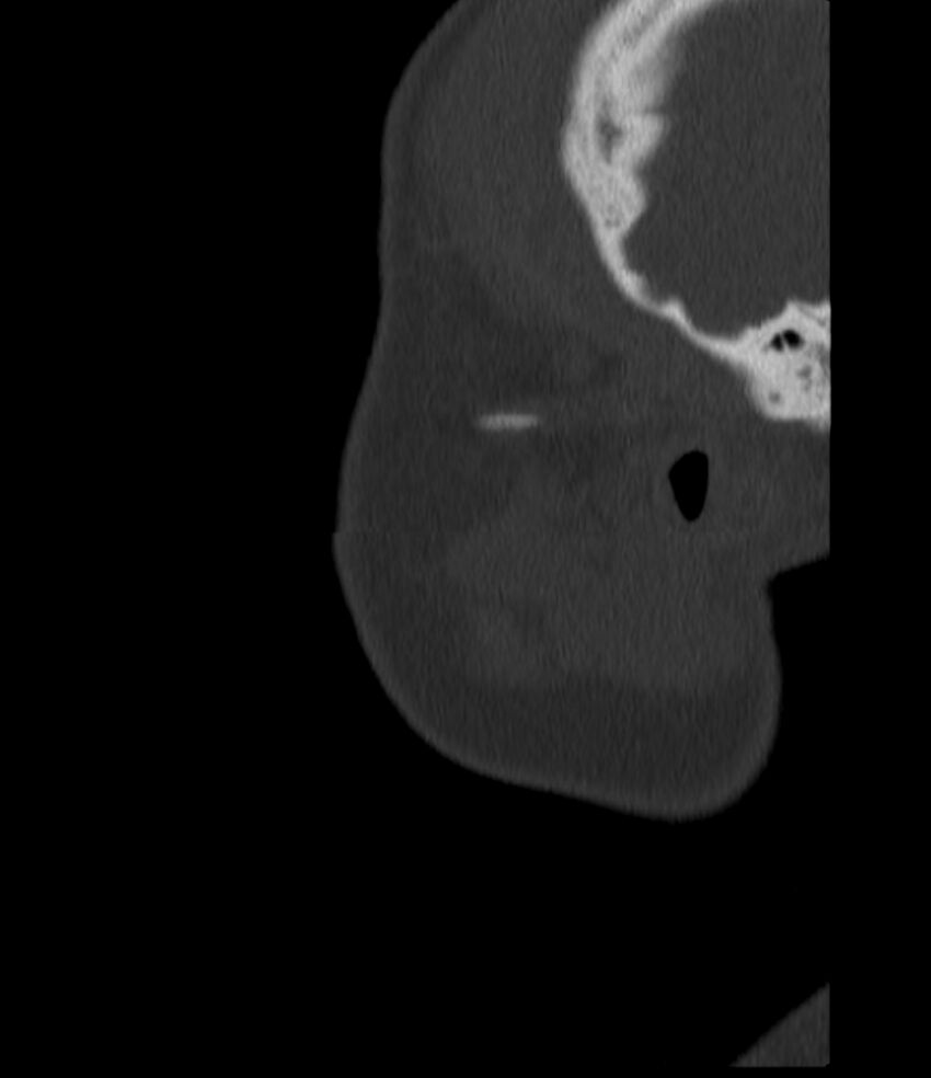Normal facial bone CT (Radiopaedia 88742-105476 Sagittal bone window 19).jpg