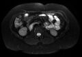 Normal liver MRI with Gadolinium (Radiopaedia 58913-66163 Axial T2 fat sat 14).jpg