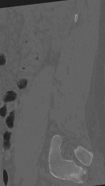File:Normal lumbar spine CT (Radiopaedia 46533-50986 Sagittal bone window 19).png