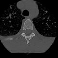 Normal trauma spine imaging (age 16) (Radiopaedia 45335-49358 Axial bone window 103).jpg