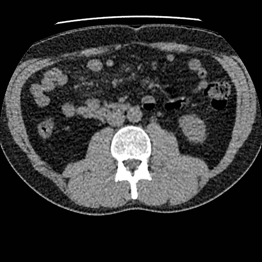 Obstructing ureteric calculus and ureteric anatomy (Radiopaedia 62730-71042 Axial non-contrast 61).jpg