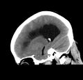 Obstructive hydrocephalus (Radiopaedia 30453-31119 C 11).jpg