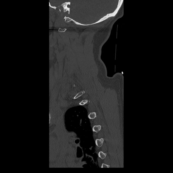 File:Occipital condyle fracture (Radiopaedia 31755-32691 Sagittal bone window 3).jpg