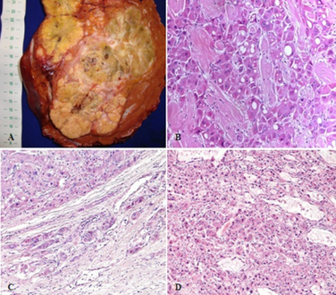 a-d)Pathological aspects of fibrolamellar hepatocellular carcinoma