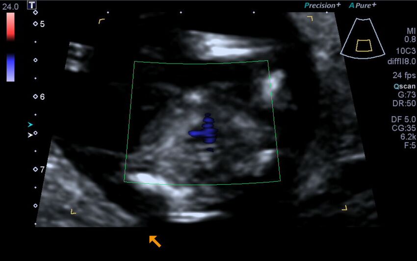 1st trimester nuchal-morphology ultrasound (Radiopaedia 44706-48477 Heart views cine with colour 168).jpg