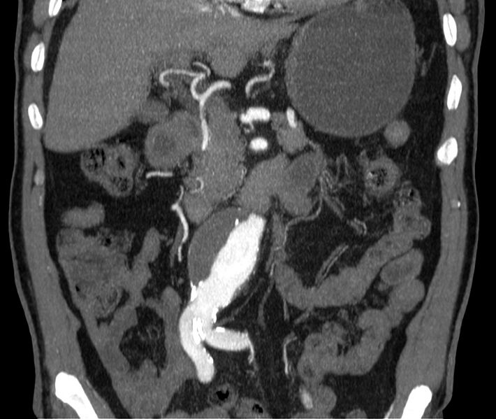 File:Abdominal aortic aneurysm (Radiopaedia 22421-22458 C 16).jpg