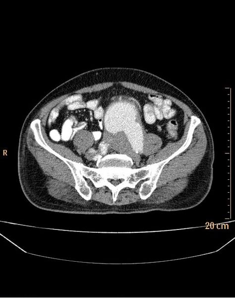 File:Abdominal aortic aneurysm (Radiopaedia 25985-26121 Axial C+ arterial phase 30).jpg