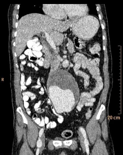 File:Abdominal aortic aneurysm (Radiopaedia 25985-26121 Coronal C+ arterial phase 14).jpg