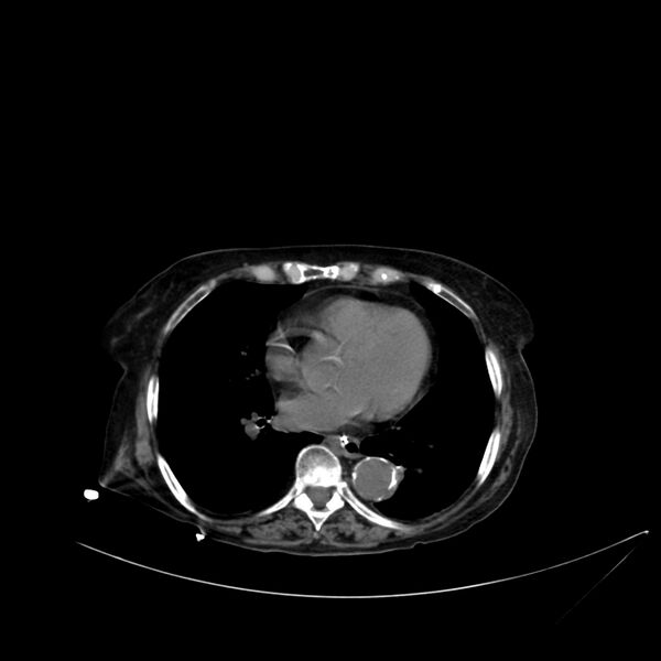 File:Abdominal aortic aneurysm - impending rupture (Radiopaedia 19233-19246 Axial non-contrast 5).jpg