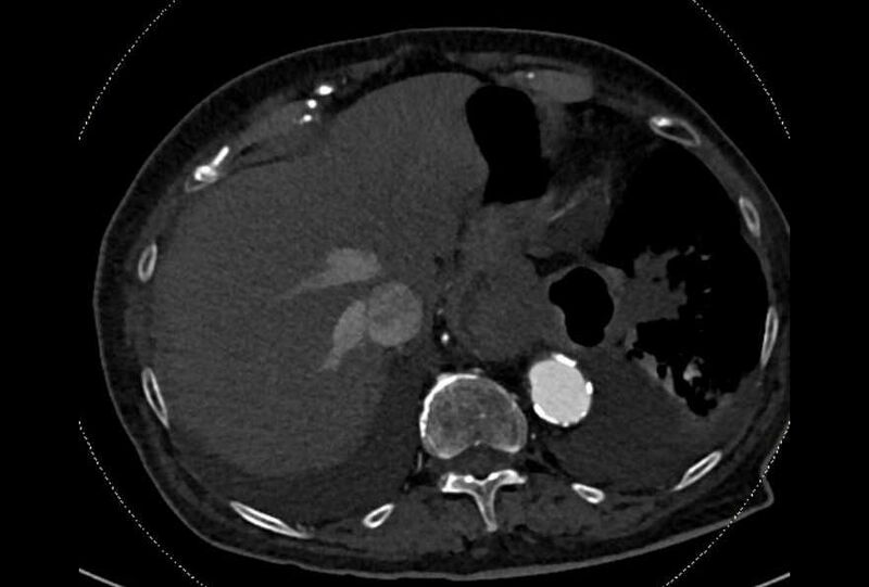 File:Abdominal aortic aneurysm with thrombus fissuration (Radiopaedia 73192-83919 Axial C+ arterial phase 7).jpg