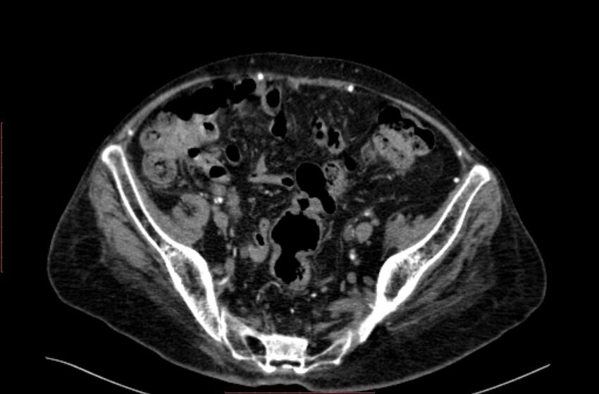 Abdominal aortic interposition tube graft and aneurysm thrombosis (Radiopaedia 71438-81857 Axial C+ arterial phase 180).jpg