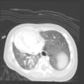 Aberrant left pulmonary artery (pulmonary sling) (Radiopaedia 42323-45435 Axial lung window 27).jpg