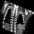 Aberrant left pulmonary artery (pulmonary sling) (Radiopaedia 42323-45435 Coronal C+ CTPA 5).jpg