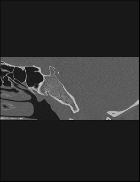 File:Aberrant right internal carotid artery (Radiopaedia 65191-74198 Sagittal non-contrast 93).jpg