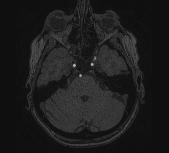 File:Accessory middle cerebral artery and ICA aneurysm (Radiopaedia 22656-22674 MRA 17).jpg