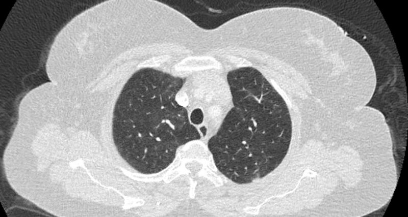 File:Accessory right inferior hepatic vein (Radiopaedia 65245-74259 Axial lung window 10).jpg
