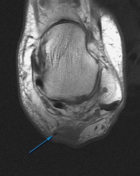 File:Achilles tendon tear (Radiopaedia 2572-18102 A 1).jpg