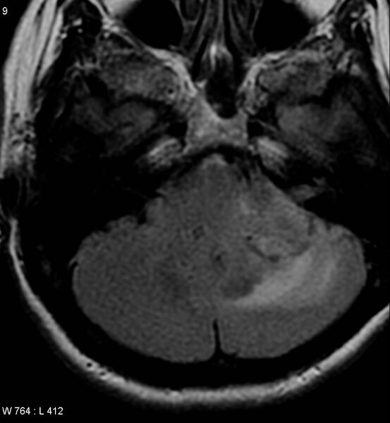 File:Acoustic schwannoma (large with cystic change) (Radiopaedia 5369-7130 Axial FLAIR 3).jpg