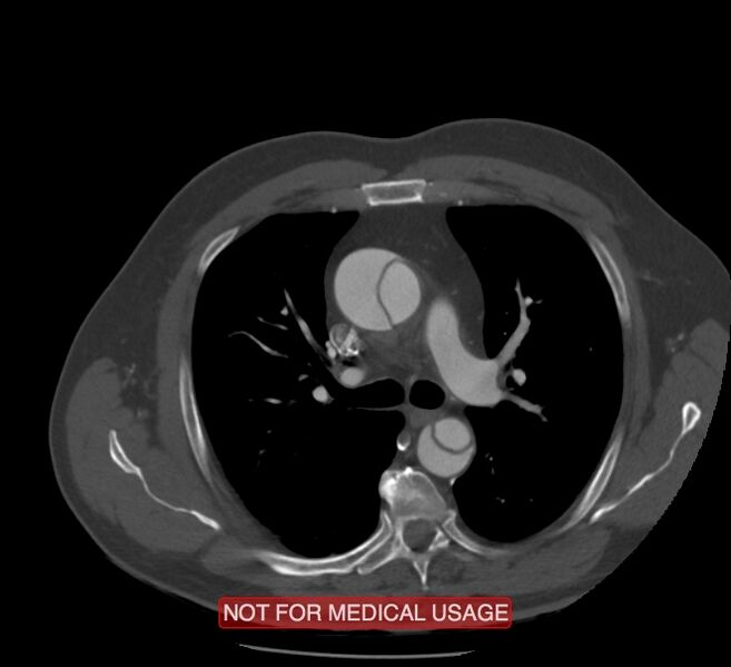 File:Acute aortic dissection - Stanford type A (Radiopaedia 40661-43285 Axial C+ arterial phase 19).jpg