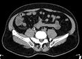 Acute appendicitis (Radiopaedia 13030-13091 Axial non-contrast 12).jpg