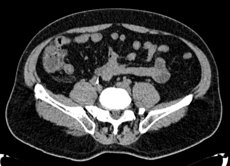 File:Acute appendicitis (Radiopaedia 13030-13091 Axial non-contrast 12).jpg