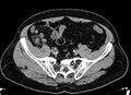 Acute appendicitis (Radiopaedia 13030-13091 Axial non-contrast 46).jpg