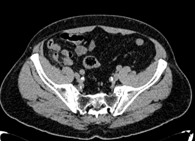 File:Acute appendicitis (Radiopaedia 13030-13091 Axial non-contrast 54).jpg
