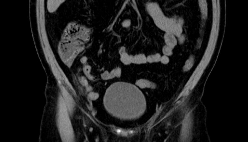 File:Acute appendicitis (Radiopaedia 13030-13091 Coronal non-contrast 5).jpg