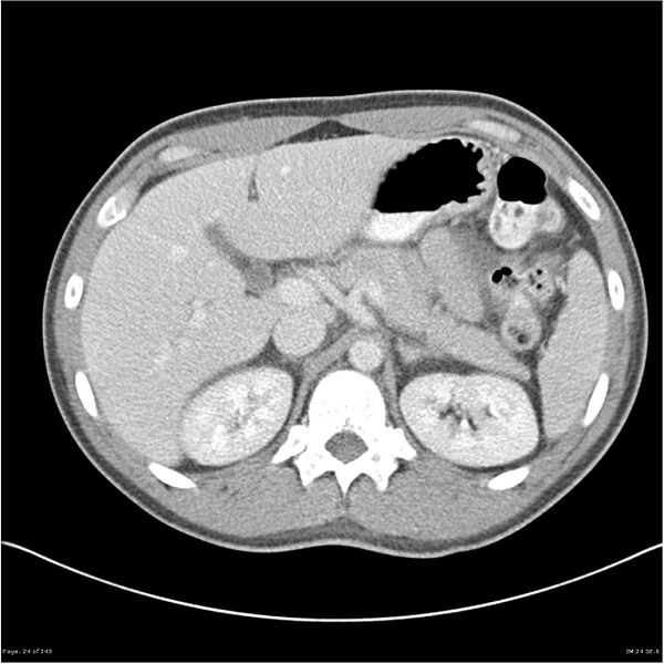 File:Acute appendicitis (Radiopaedia 25364-25615 B 14).jpg