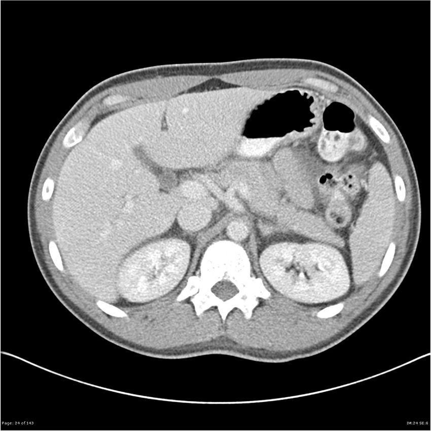 Acute appendicitis (Radiopaedia 25364-25615 B 14).jpg