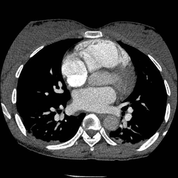 File:Acute chest syndrome - sickle cell disease (Radiopaedia 42375-45499 Axial C+ CTPA 103).jpg