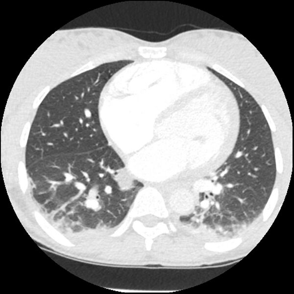 File:Acute chest syndrome - sickle cell disease (Radiopaedia 42375-45499 Axial lung window 118).jpg