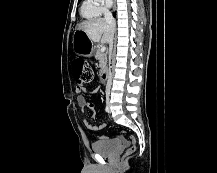 File:Acute cholecystitis (Radiopaedia 53216-59182 Sagittal C+ portal venous phase 12).jpg