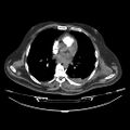 Acute heart failure (CT) (Radiopaedia 79835-93075 Axial C+ arterial phase 19).jpg