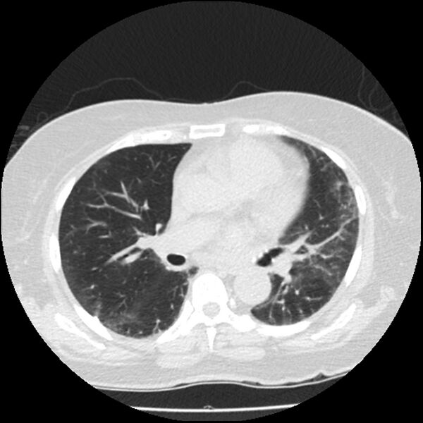 File:Acute interstitial pneumonitis (Radiopaedia 45404-49444 Axial lung window 53).jpg