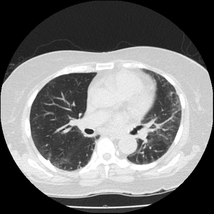 Acute interstitial pneumonitis (Radiopaedia 45404-49444 Axial lung window 53).jpg