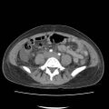 Acute myocarditis (Radiopaedia 55988-62613 Axial C+ portal venous phase 48).jpg