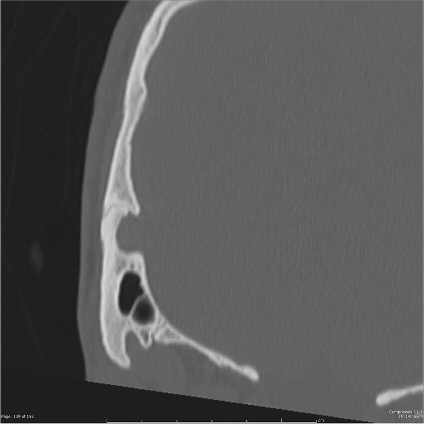 Acute otomastoiditis (Radiopaedia 28276-28512 Coronal PTB bone window reformat 70).jpg