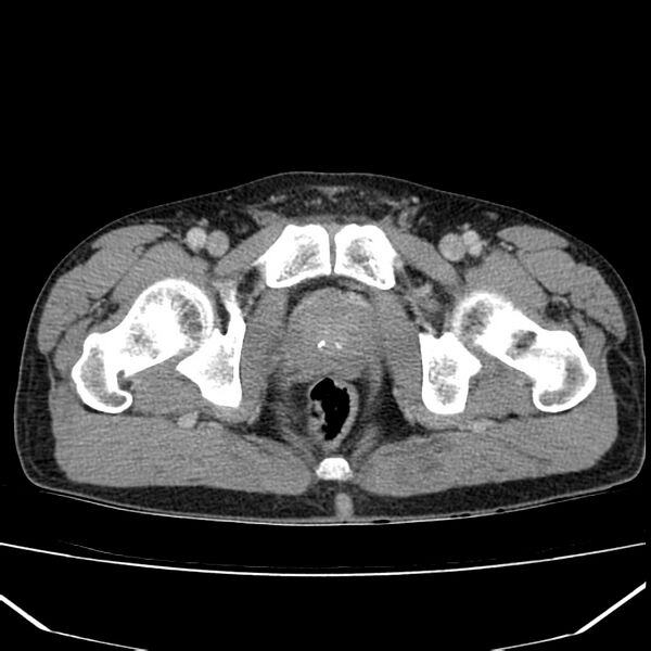 File:Acute pancreatitis (Radiopaedia 22572-22596 Axial C+ portal venous phase 73).jpg